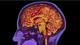 How Dementia Spreads Through Brain