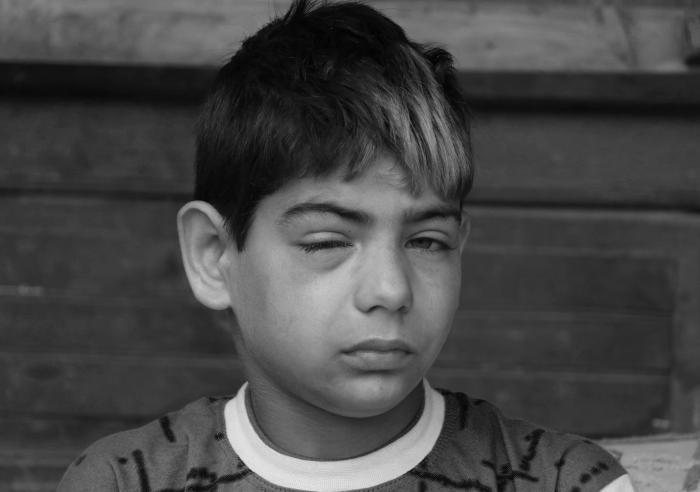 (Shahid at his Kareemabad home after he was hit by pellets fired by government forces in his village at Pulwama in South Kashmir on May 28, 2020. The eight-year-old, born 15 years after his parents were married, is undergoing treatment for one of his eyes, but is not sure if he can see properly again). Picture: Kamran Yousuf/NewsClick