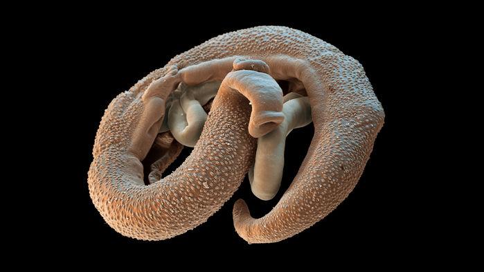 schistosomiasis
