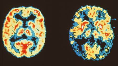 Brains without (left) and with (right) Alzheimer’s disease; Figure courtesy Science Magazine