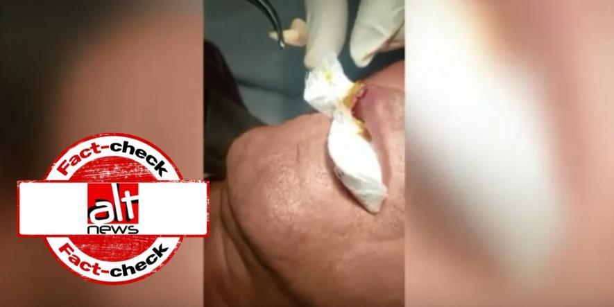 Video of Parasite Removal from a Person’s lip Falsely Linked With Coronavirus