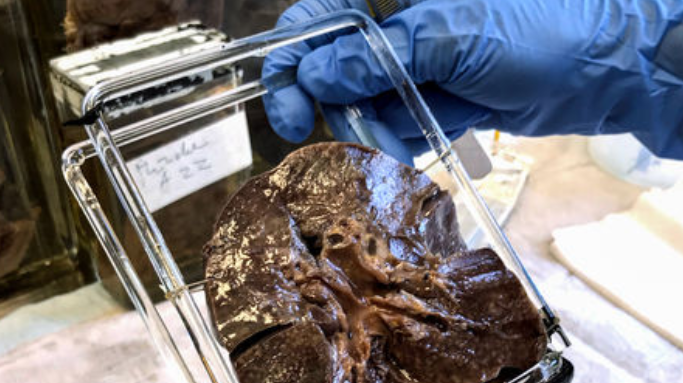 mage Courtesy: Science magazine. Image depicts Scientists assembled a measles virus genome from the preserved lungs of a girl who died in 1912