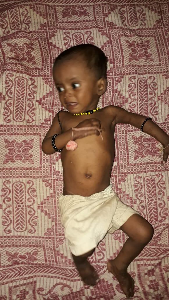 To the baby who is in bed is Rupali Taral, severely acute mal-nourished