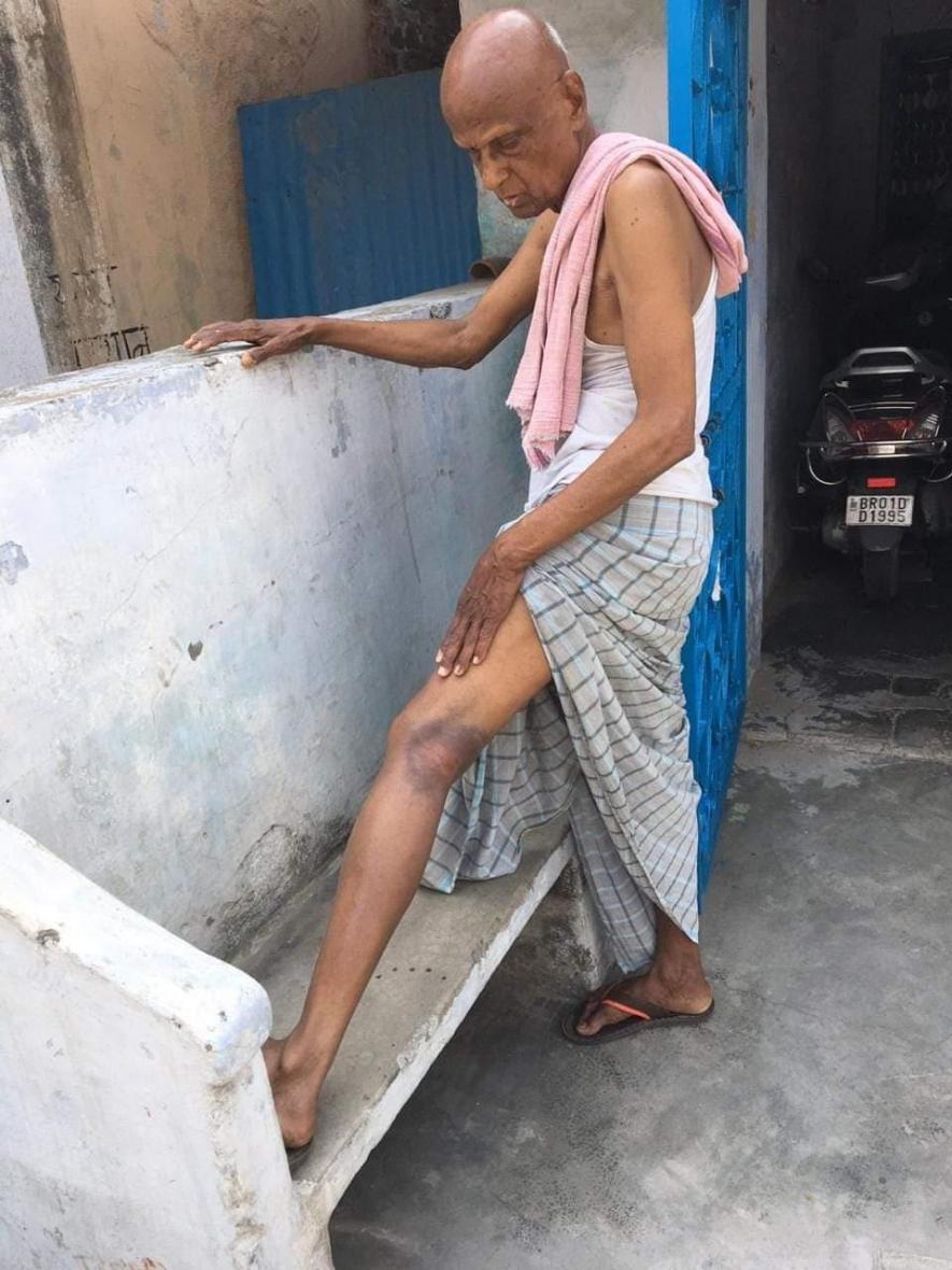 RTI activist Girish Gupta with beaten marks on leg