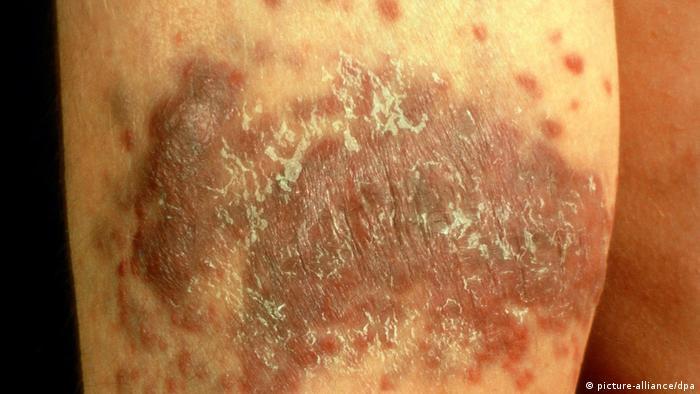 Kaposi's Sarcoma is a common condition associated with AIDS