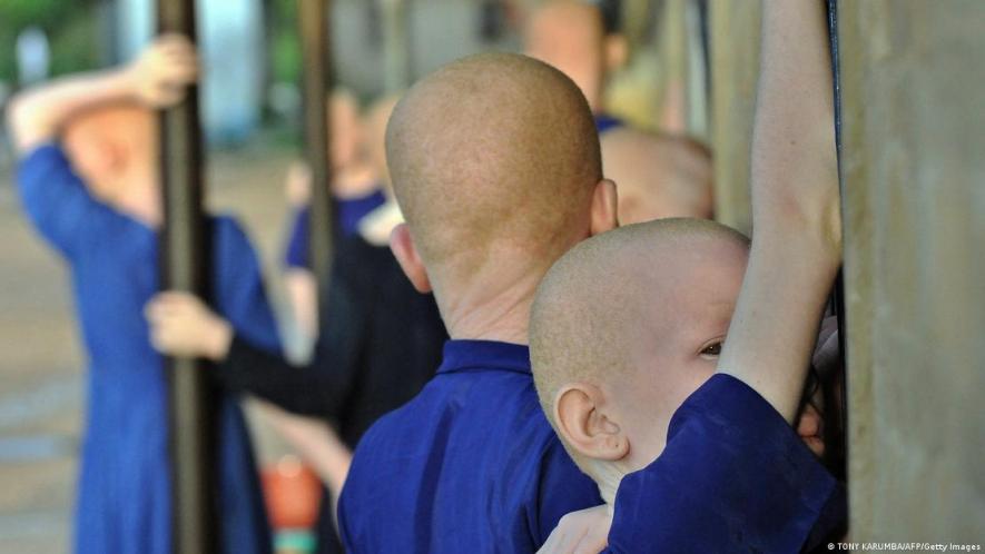 Persons born with albinism often face stigma and other myths