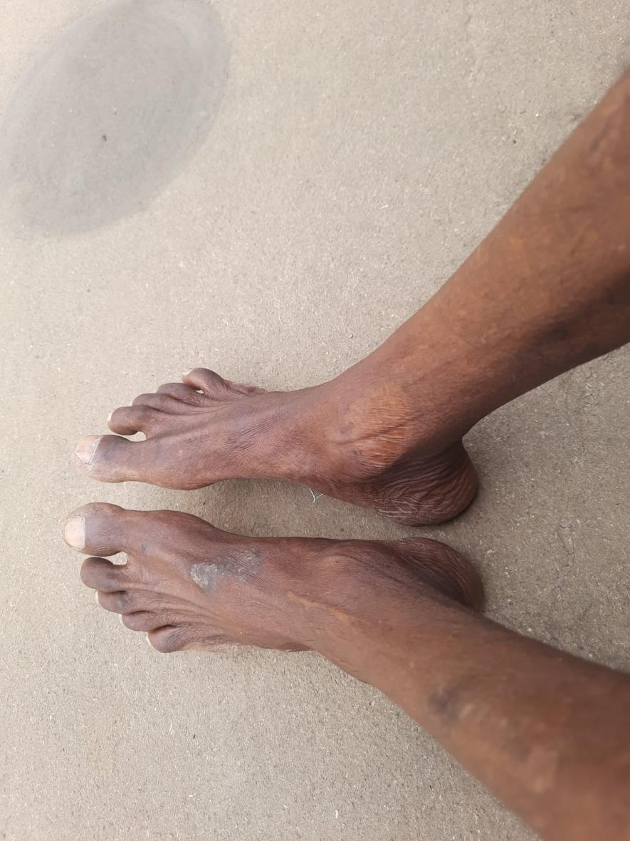 People in villages like Chantikocha and Bango have persistent skin problem