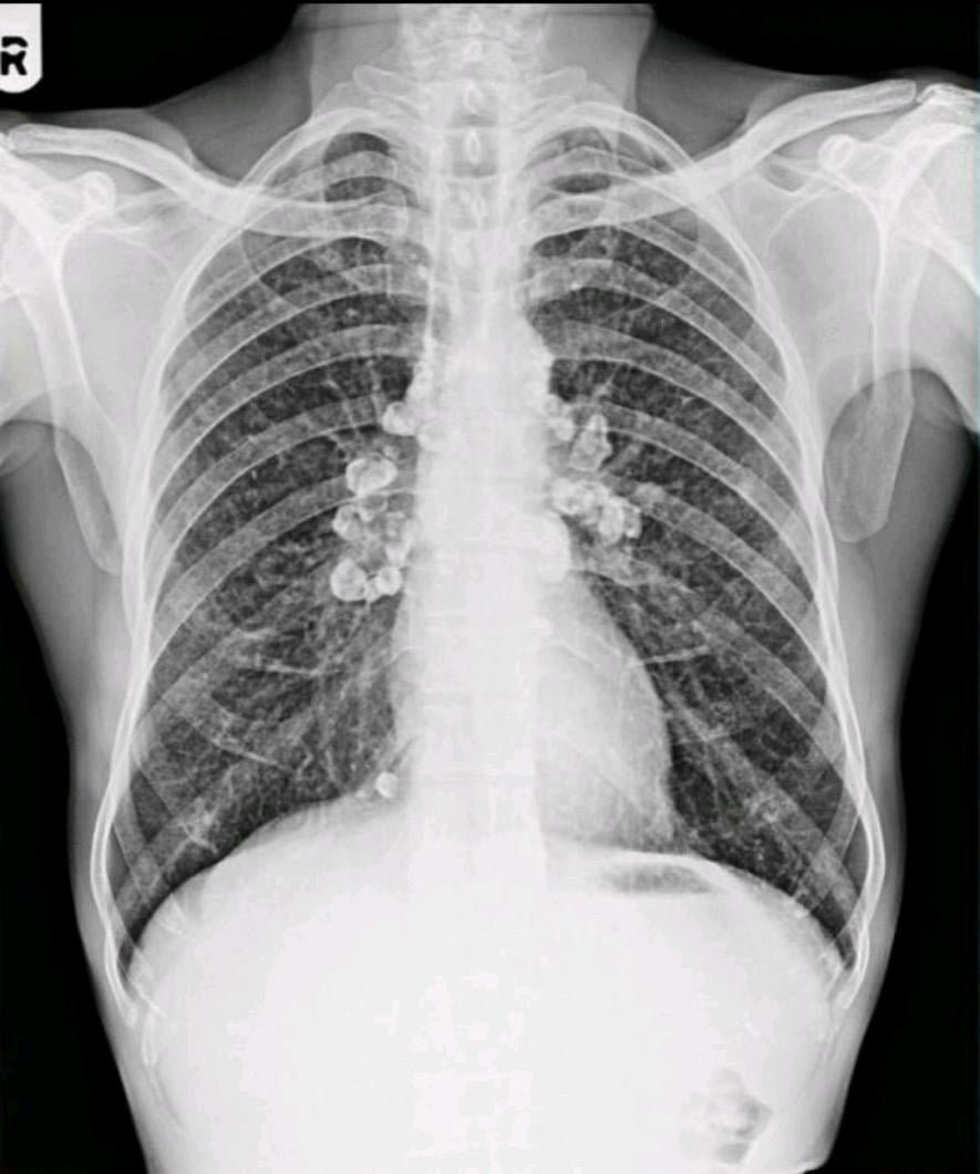 An X-ray of the lungs of a silicosis patient. 