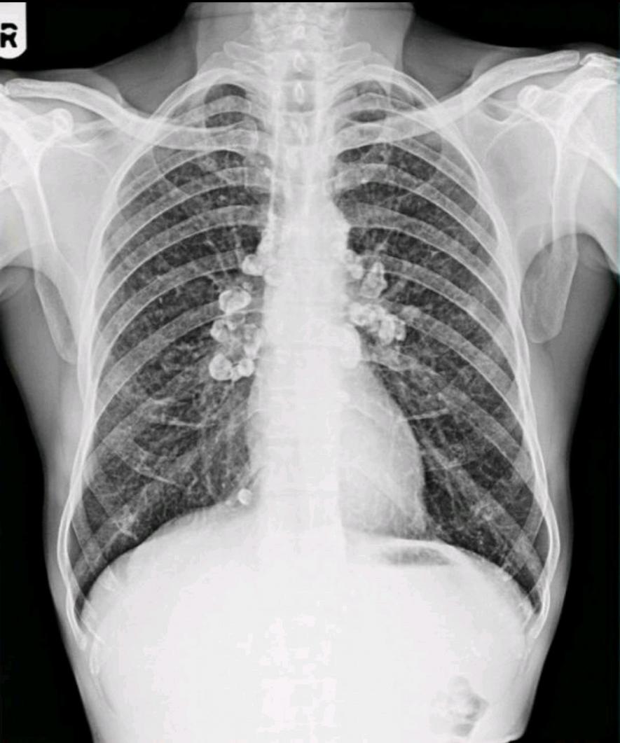 An X-ray of the lungs of a silicosis patient.